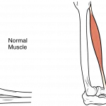 Pilvo riebalai ir raumenų praradimas gali būti pavojingesni nei manoma