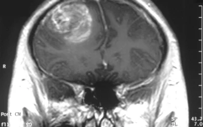 Mokslininkai atrado naują glioblastomos augimą skatinančių smegenų ląstelių tinklą